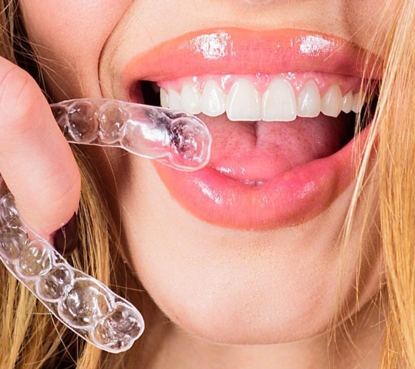 Proalign Smile Shop Clear Aligners